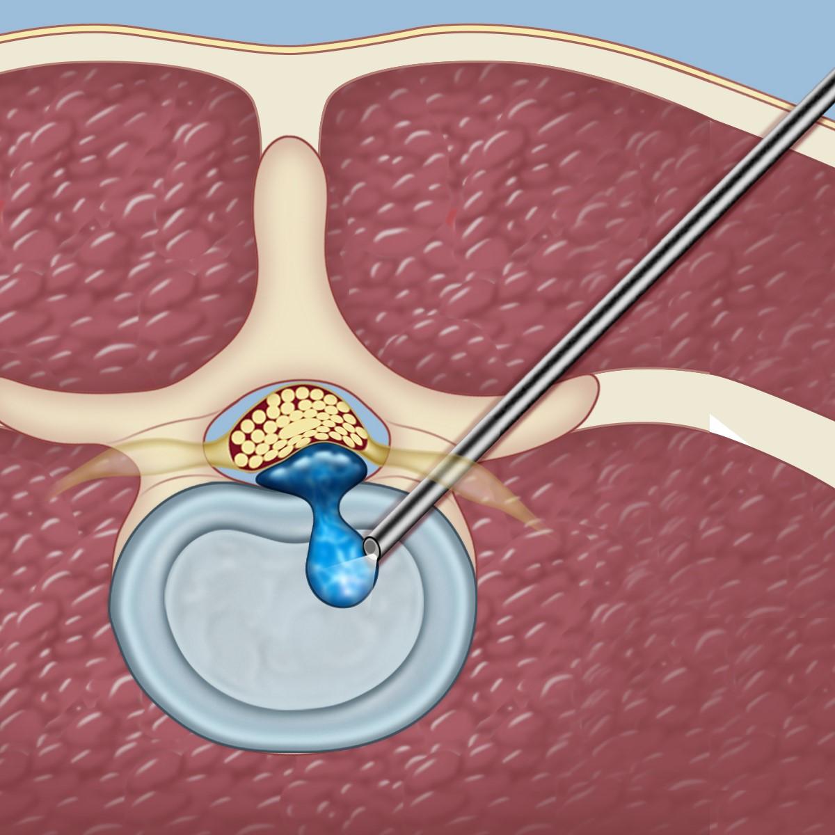 Spinal Endoscopic Surgery